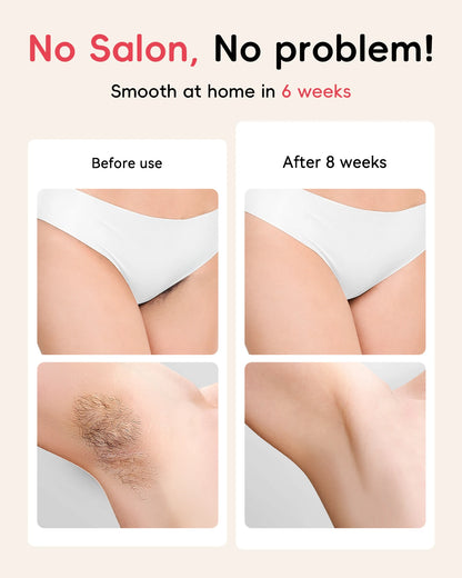 SmoothSkin Laser Hair Remover